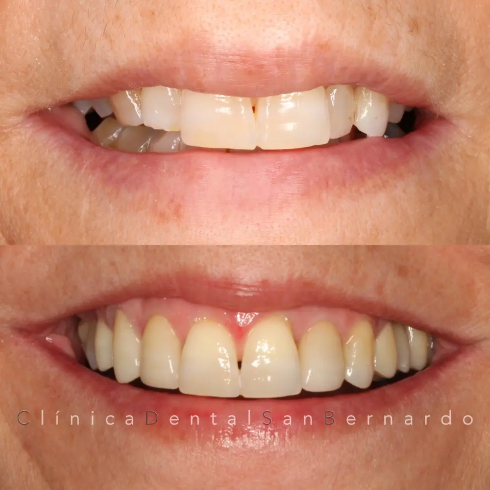 Transformación Integral con Ortodoncia y Estética Dental